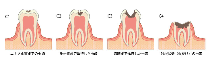 虫歯治療