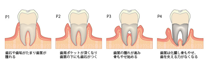 歯周病治療